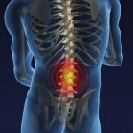 Hernia-discal-lumbar