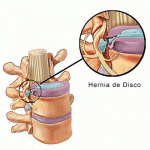 hernia de disco