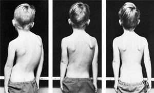 schroth-method-boy-before-and-after