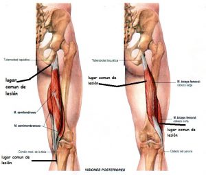 isquitibial10