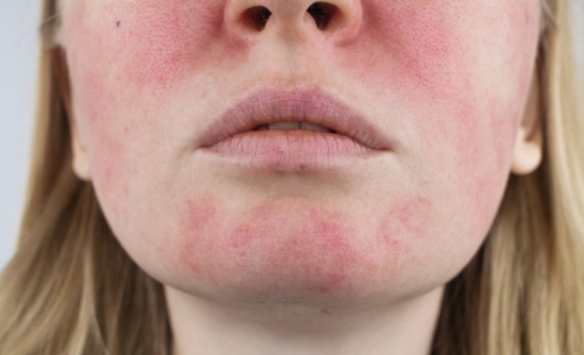 Noviembre 2025: Fisioterapia Dermatofuncional Facial con técnicas fotosensibles