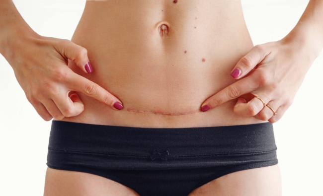 Fisioterapia en el Tratamiento de Cicatrices