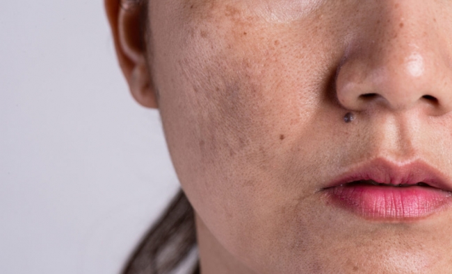 Noviembre 2025: Fisioterapia Dermatofuncional Facial con técnicas fotosensibles
