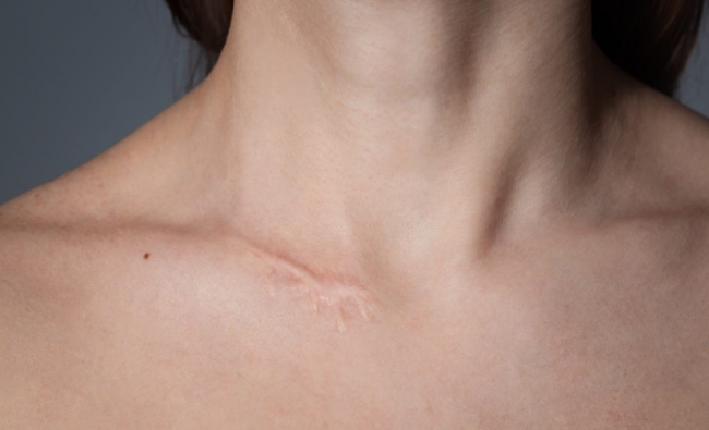 Fisioterapia en el Tratamiento de Cicatrices