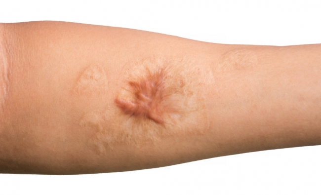 Fisioterapia en el Tratamiento de Cicatrices