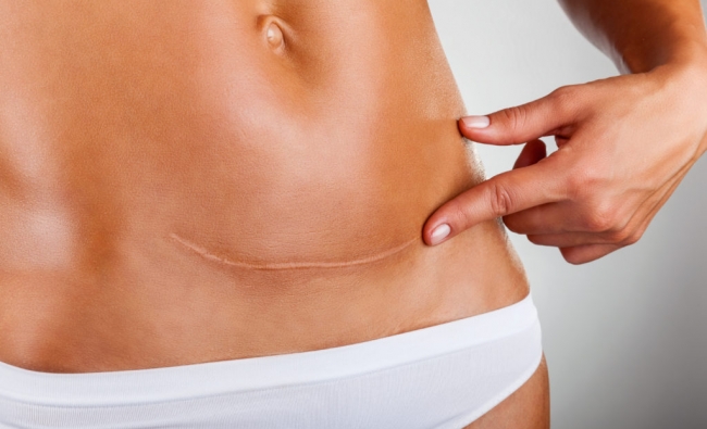 Fisioterapia en el Tratamiento de Cicatrices