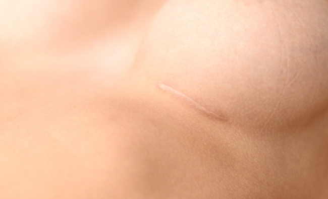 Fisioterapia en el Tratamiento de Cicatrices
