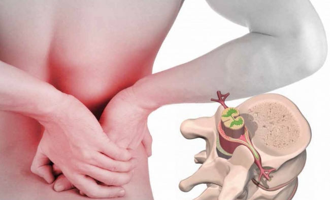 CONFERENCIA GRATUITA: Fisiopatología y Tratamiento de las Hernias Discales