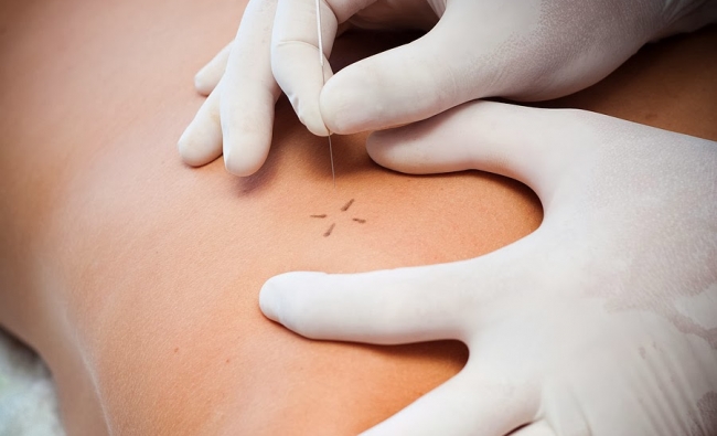 Dry Needling and Myofascial pain syndrome in physiotherapy. Level II (ADVANCED)