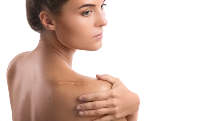 Fisioterapia en el Tratamiento de Cicatrices