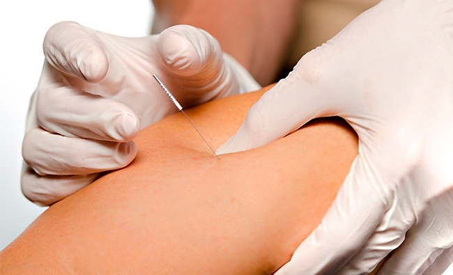 Dry Needling and Myofascial pain syndrome in physiotherapy. Level II (ADVANCED)