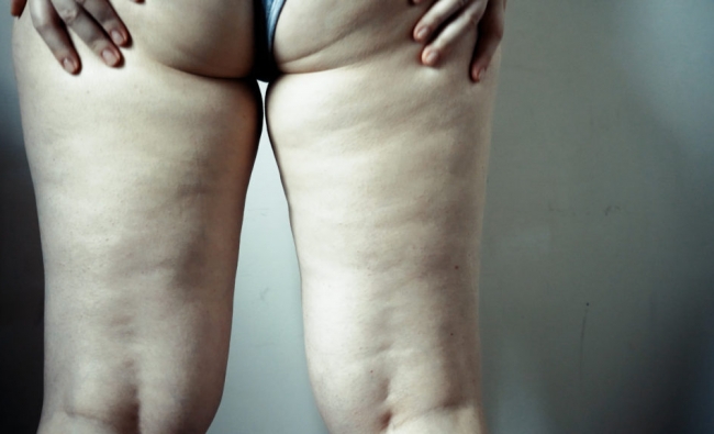 Abordaje del Lipedema desde la Fisioterapia Dermatofuncional