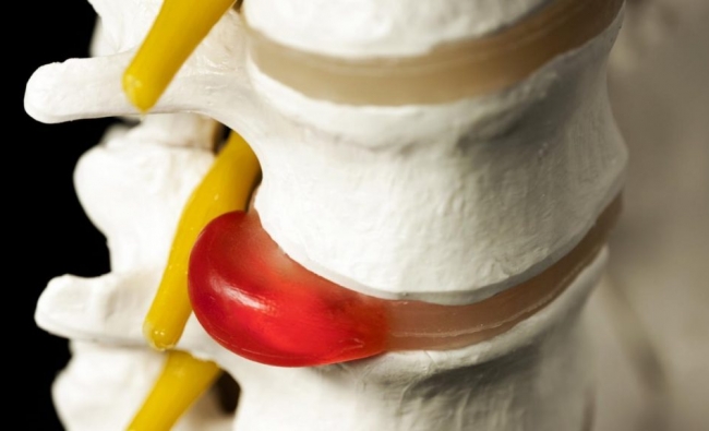 Fisioterapia en las cervicalgias, cefaleas y hernias discales