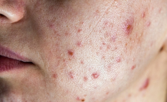Noviembre 2025: Fisioterapia Dermatofuncional Facial con técnicas fotosensibles