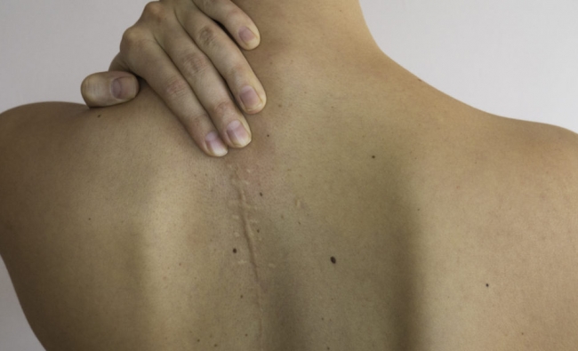 Fisioterapia en el Tratamiento de Cicatrices